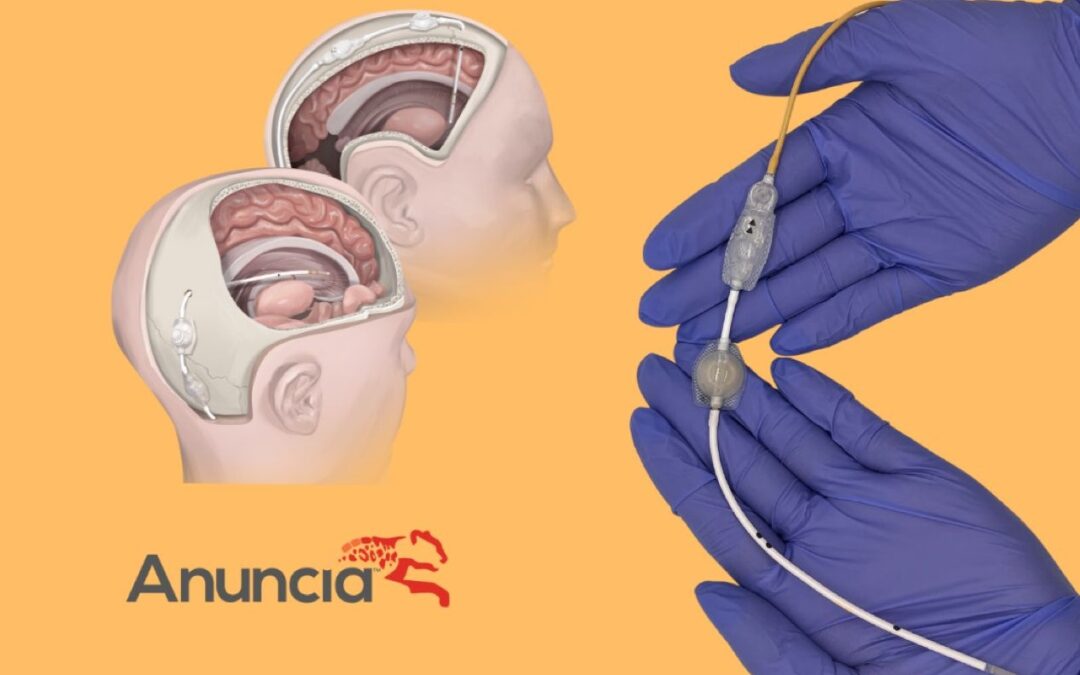 Anuncia Medical Inc. Announces Published Data with Promising Clinical Outcomes Using the ReFlow™ Ventricular System In-Line with Hydrocephalus Shunts